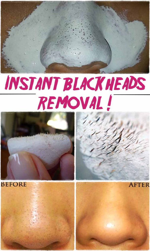 Beauty Tips For Blackheads