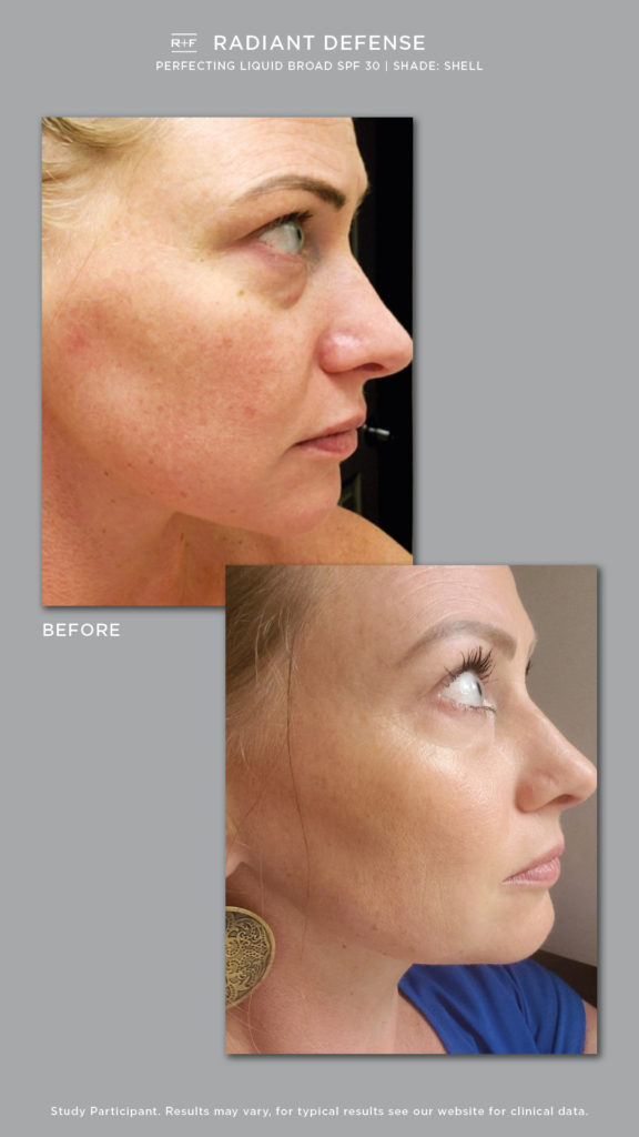 rodan and fields spotless before and after rodan and fields spotless before and after