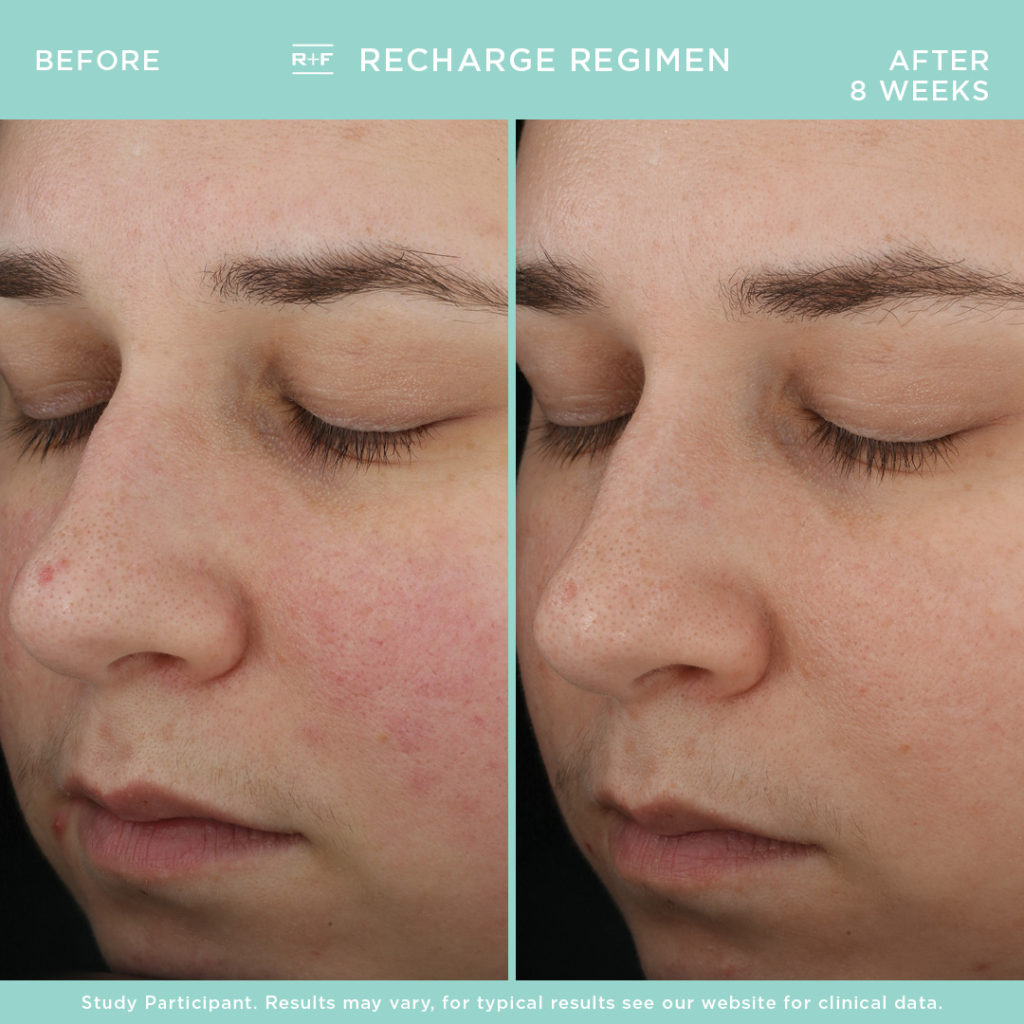 rodan and fields spotless before and after