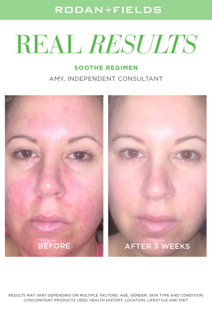 Rodan and Fields Before and After