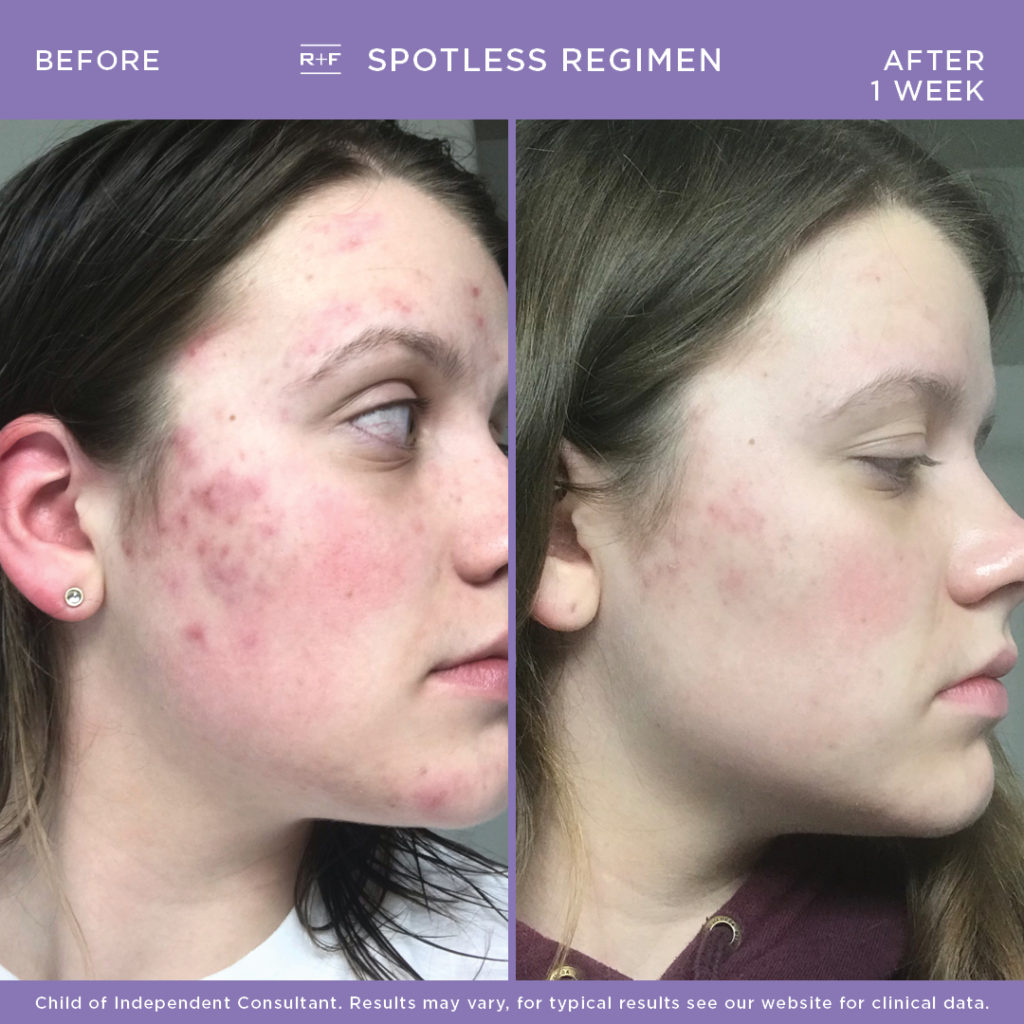 radiant defense before and after